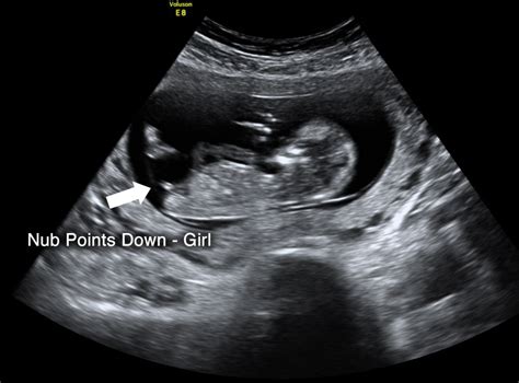 how accurate is dating scan at 14 weeks